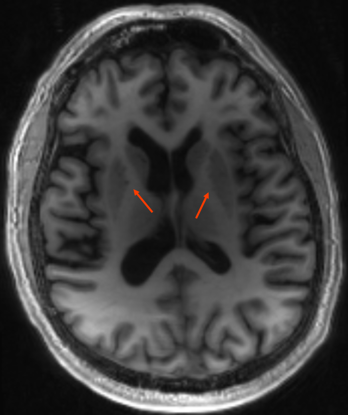 Capsula interna MRI MDEFT Sequenz