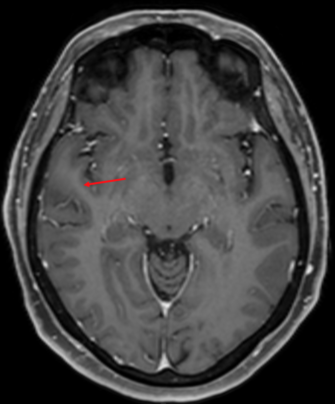Gyrus temporalis superior im MRI.