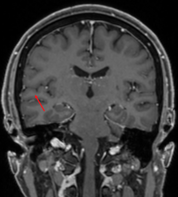 Gyrus temporalis superior im MRI.