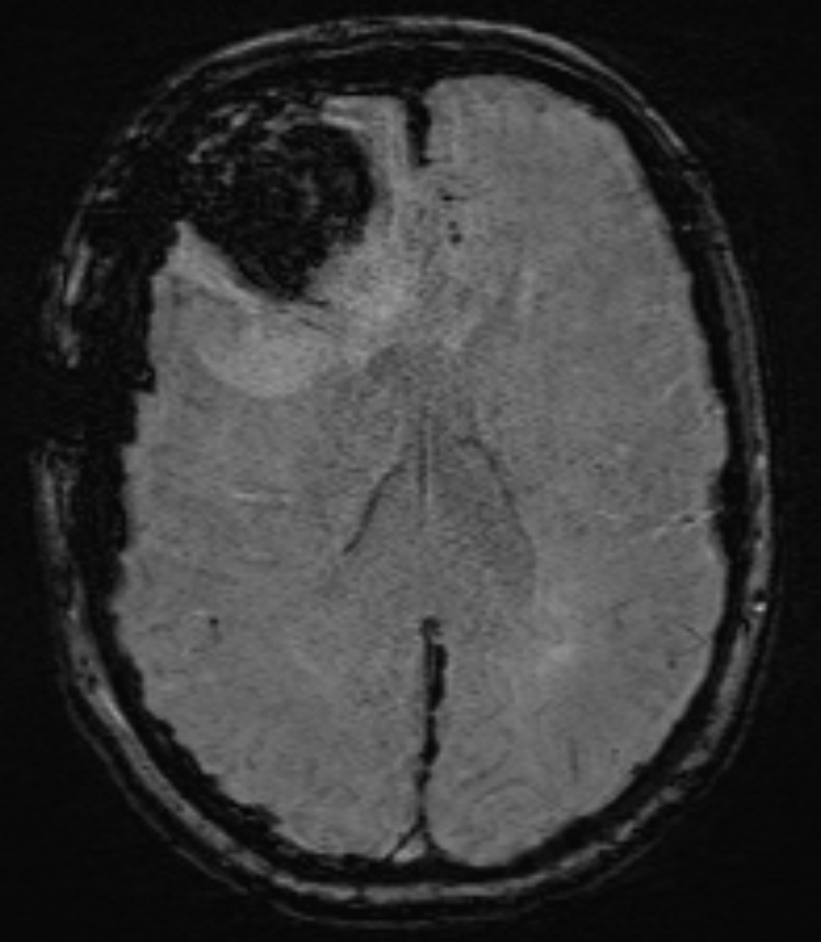 MRI SWI Sequenz einer Kontusionsblutung