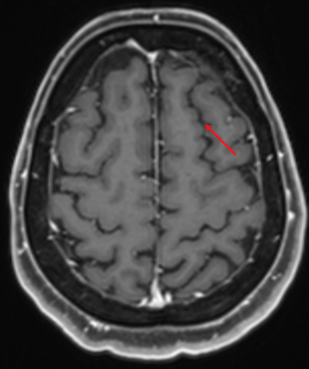 Sulcus frontalis superior im MRI.