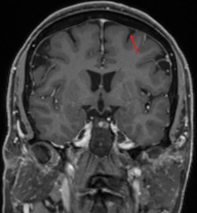 Sulcus frontalis superior MRI