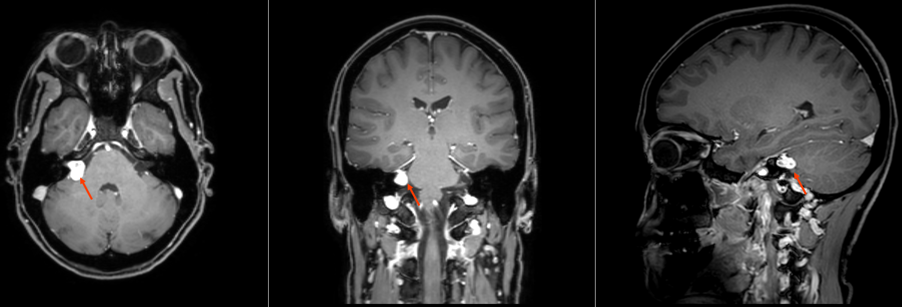 MRI Vestibularisschwannom