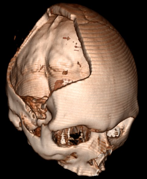 CT Rekonstruktion dekompressive Hemikraniektomie
