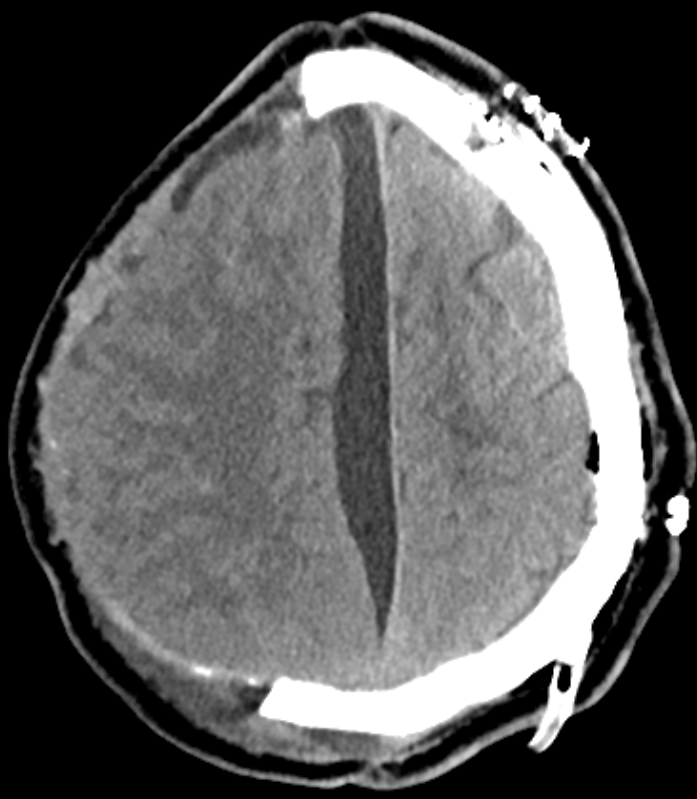 Interhemisphärisches Hygrom im CT