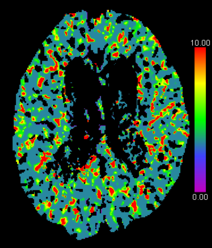 MTT CT Perfusion