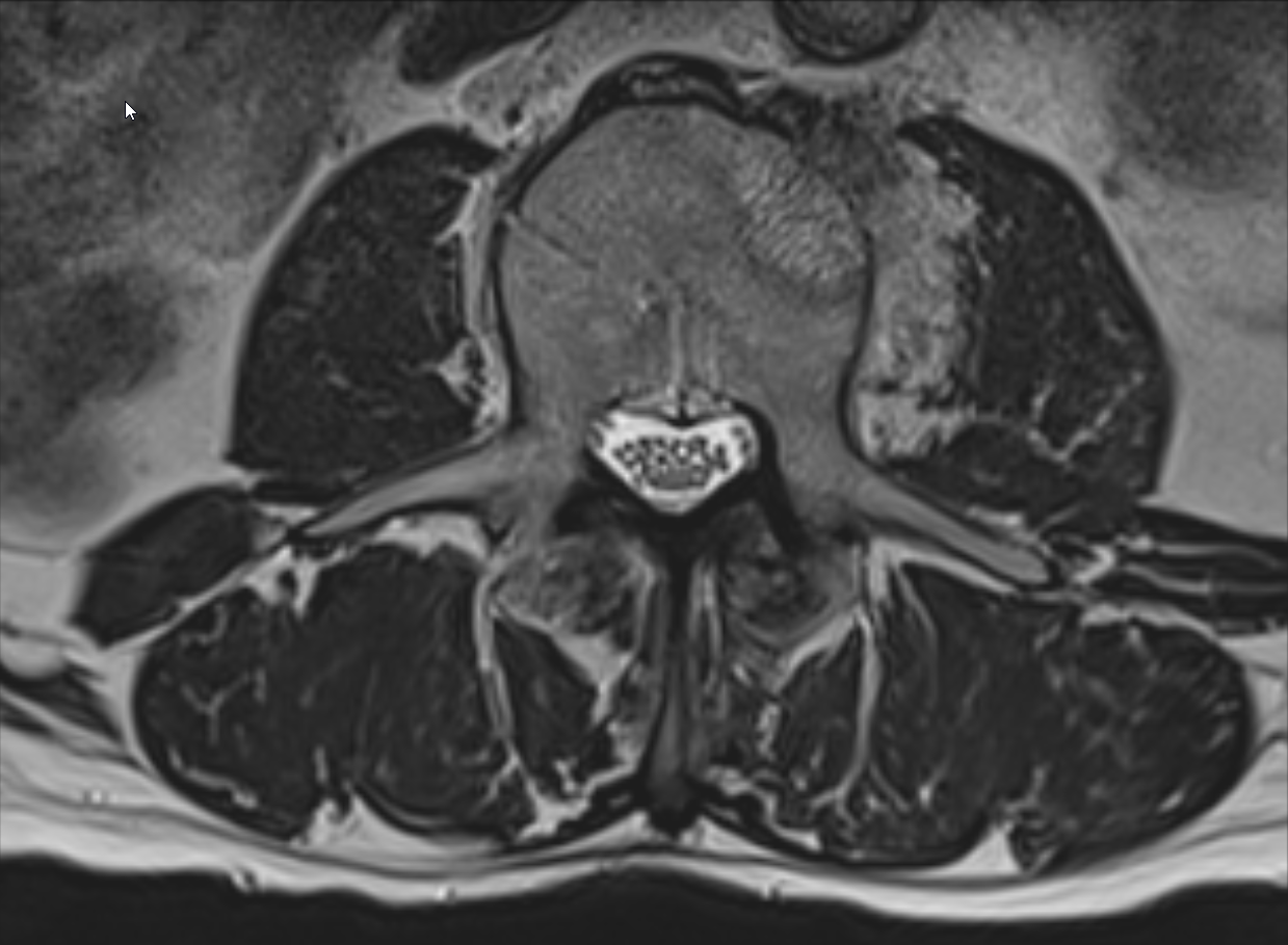 Normaler Spinalkanal im axialen T2 MRI