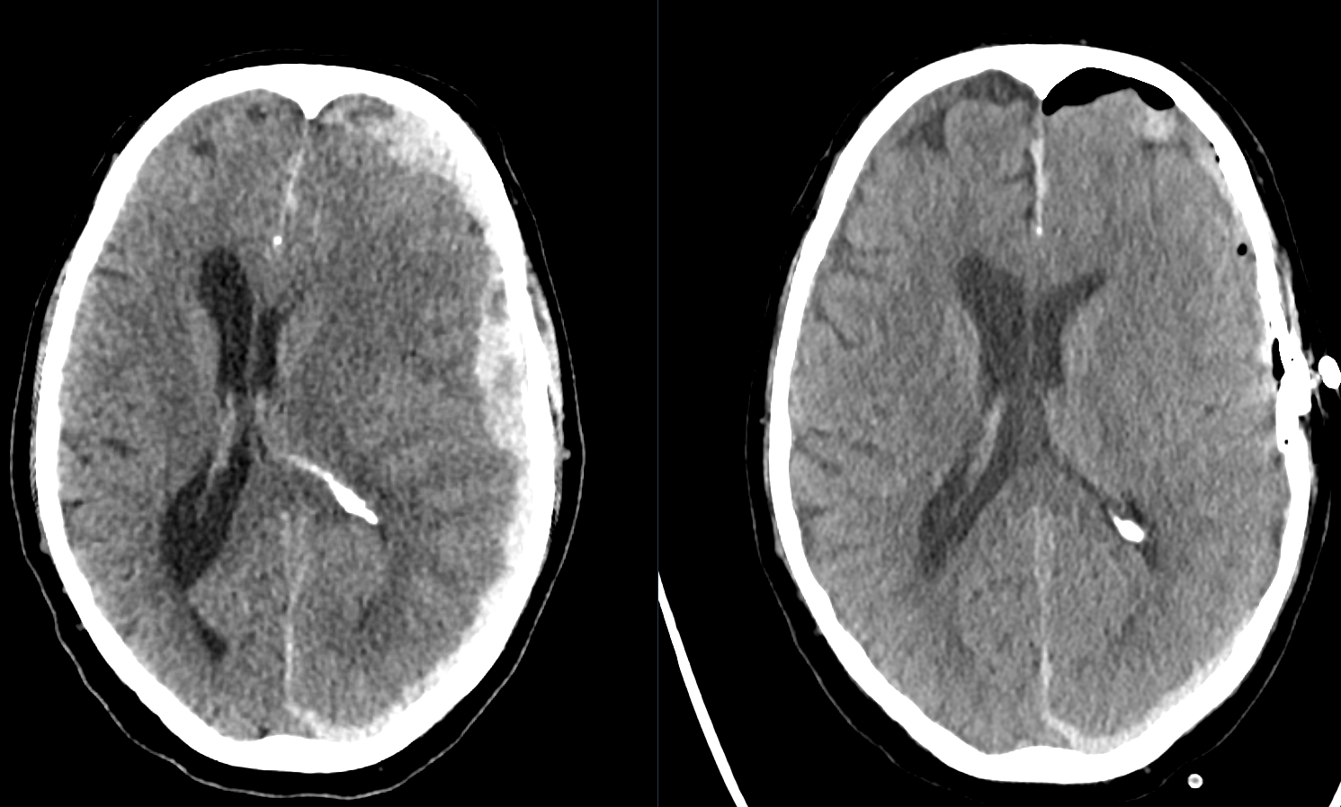 Akutes Subduralhämatom - Ars Neurochirurgica