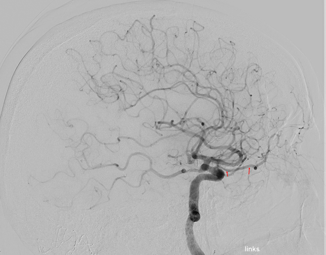 Angiographie der Arteria ophthalmica