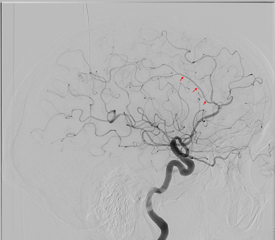 Angiographie der Arteria pericallosa