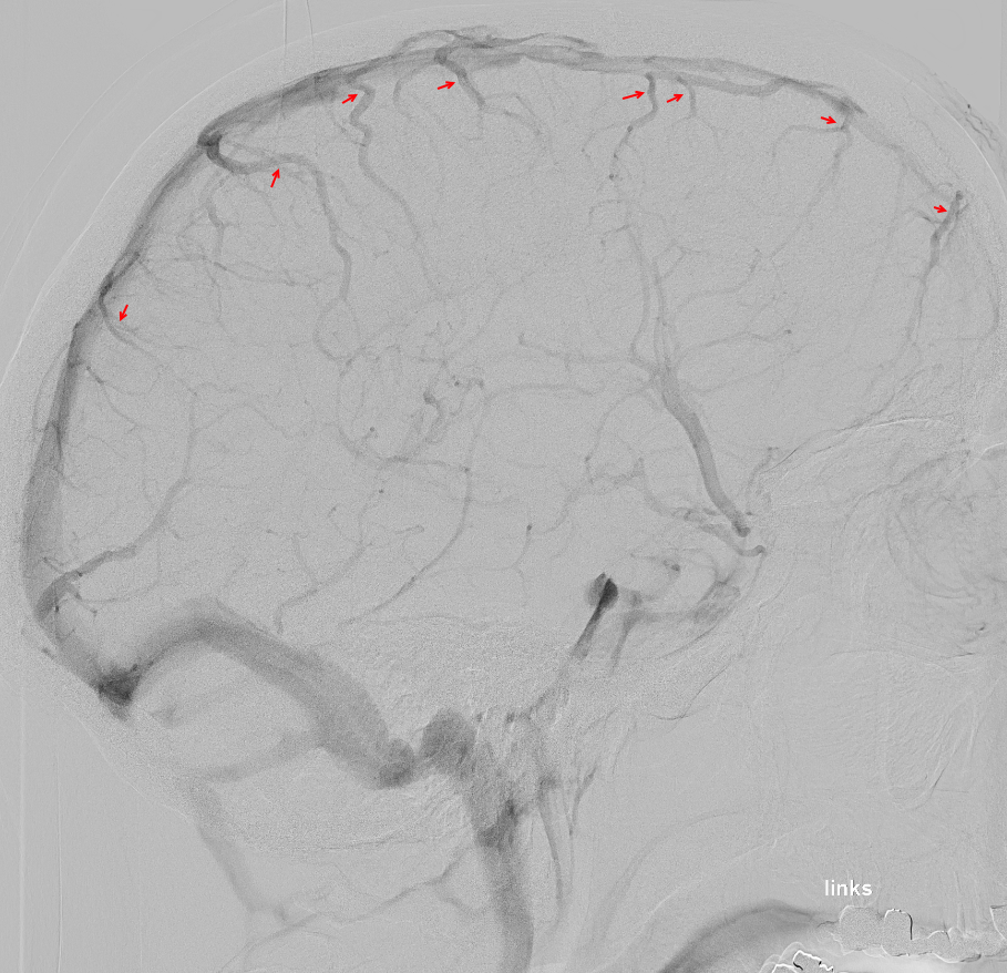 Brückenvenen in einer Angiographie
