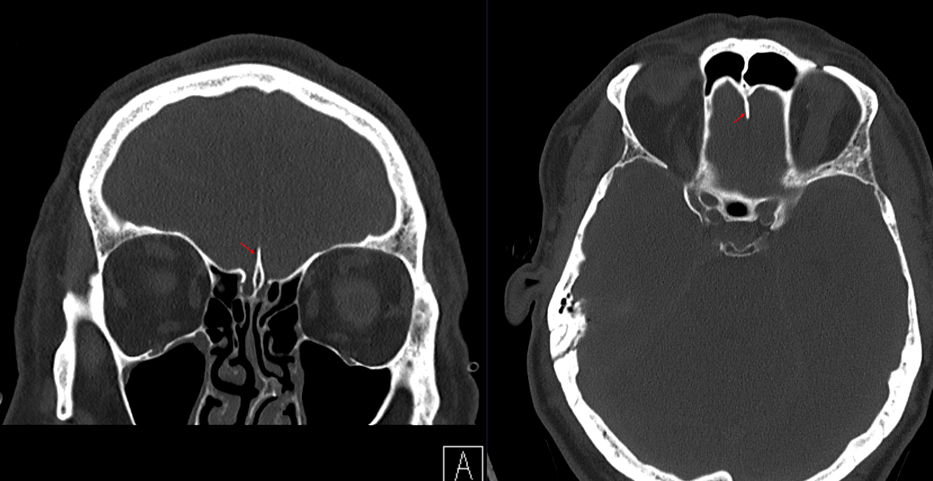 Crista galli on a CT