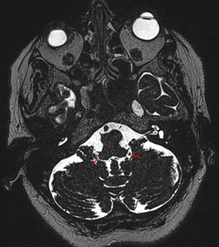 Foramen Luschkae im MRI