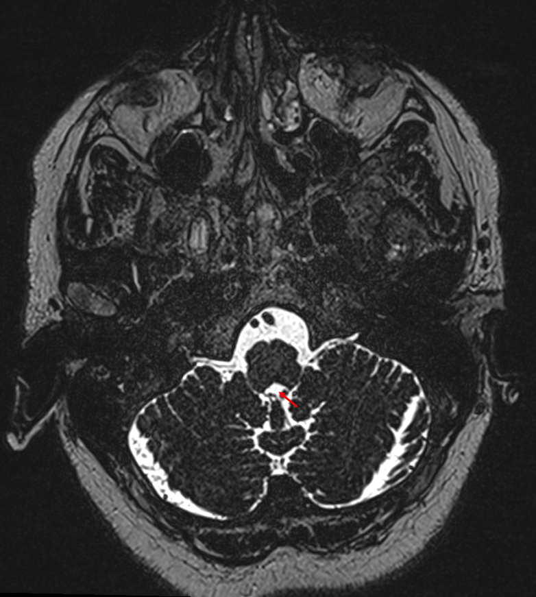 Foramen magendie im MRI