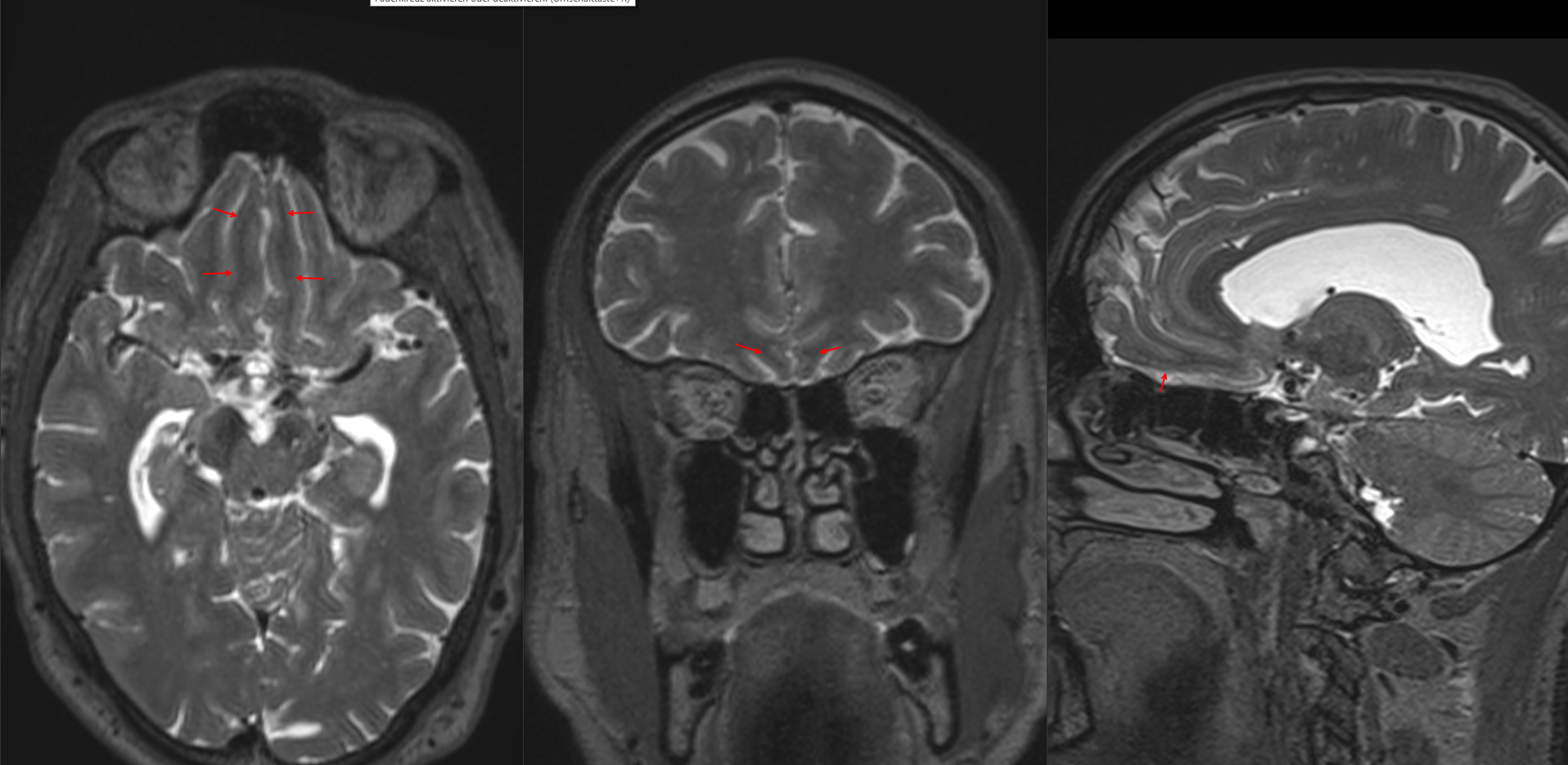 Gyrus rectus im MRI