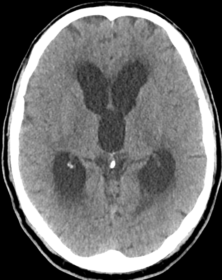 Hydrocephalus malresorptivus im CT