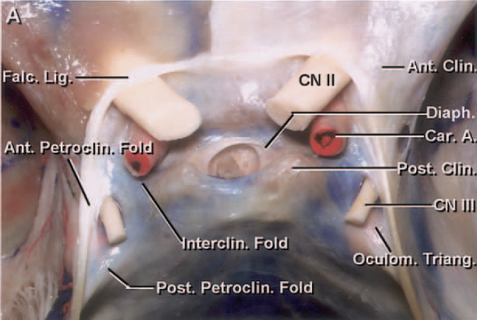 Ligamentum falciforme