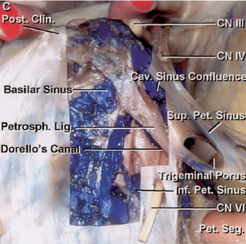 Ligamentum sphenopetrosum