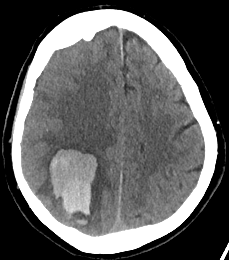 Intrazerebrale Lobärblutung CT