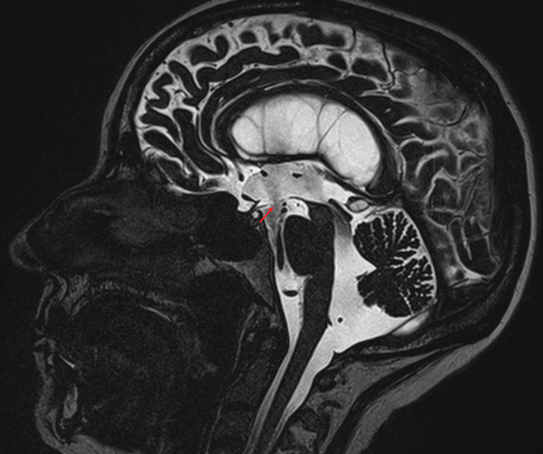 CISS MRI nach Drittventrikulostomie