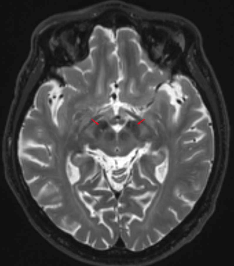 Nucleus subthalamicus MRI T2