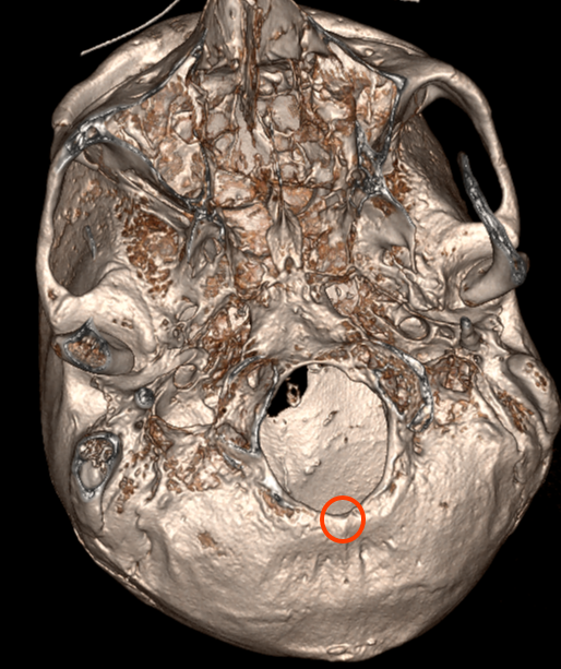 Opisthion CT Rekonstruktion