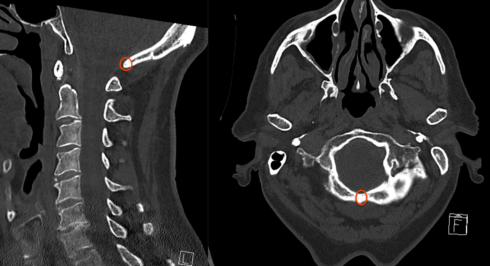 Opisthion im CT