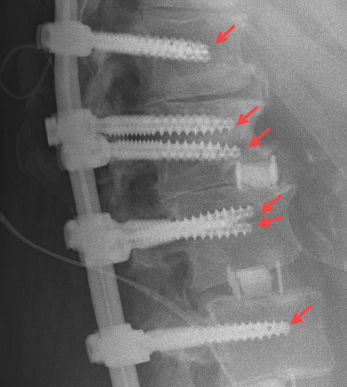 Pedikelschrauben im Röntgen
