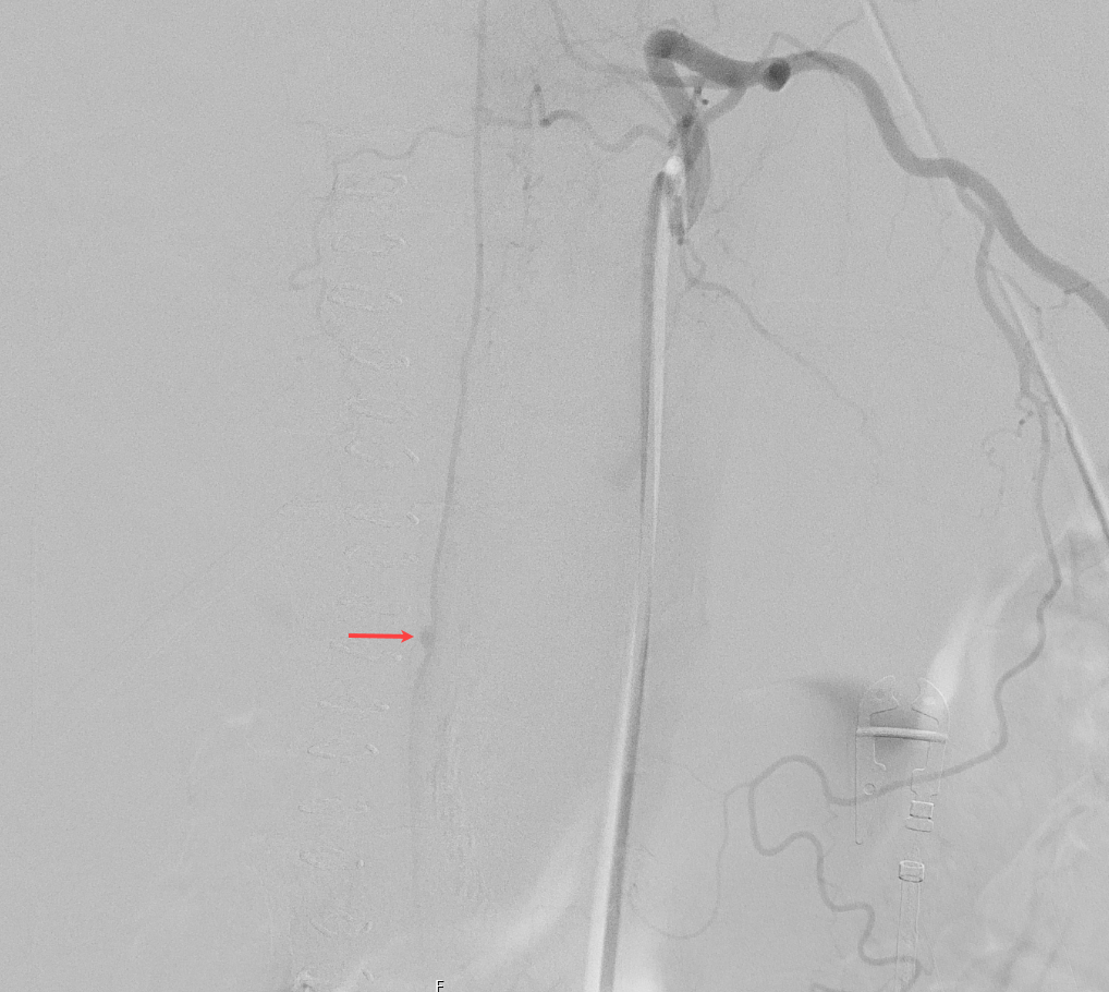 Arteria spinalis anterior Aneurysma Angiographie