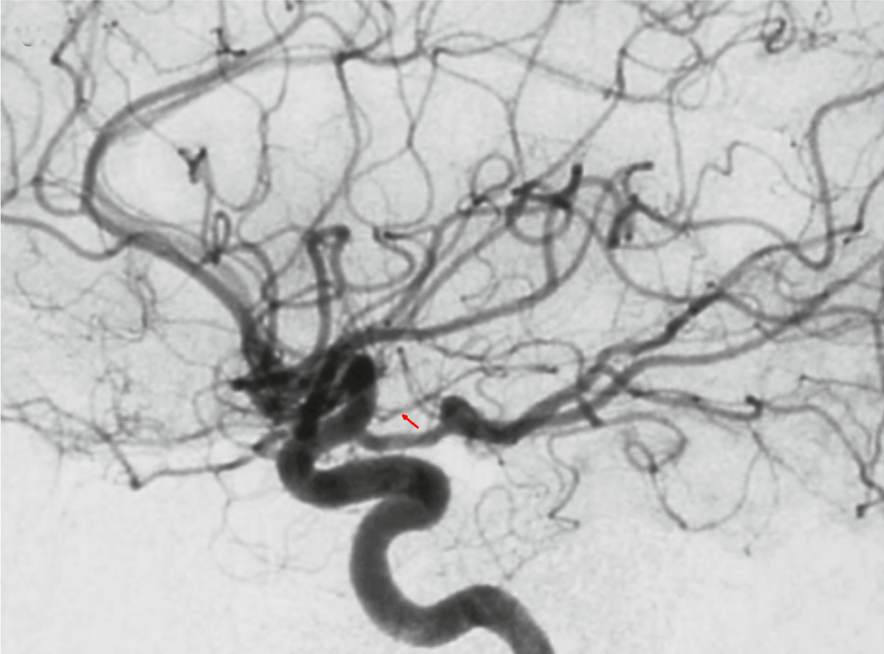 Arteria choroidea anterior Angiographie