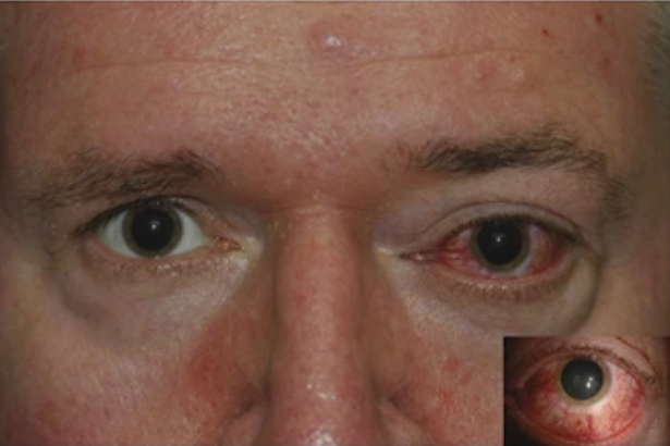 CC Fistel Auge