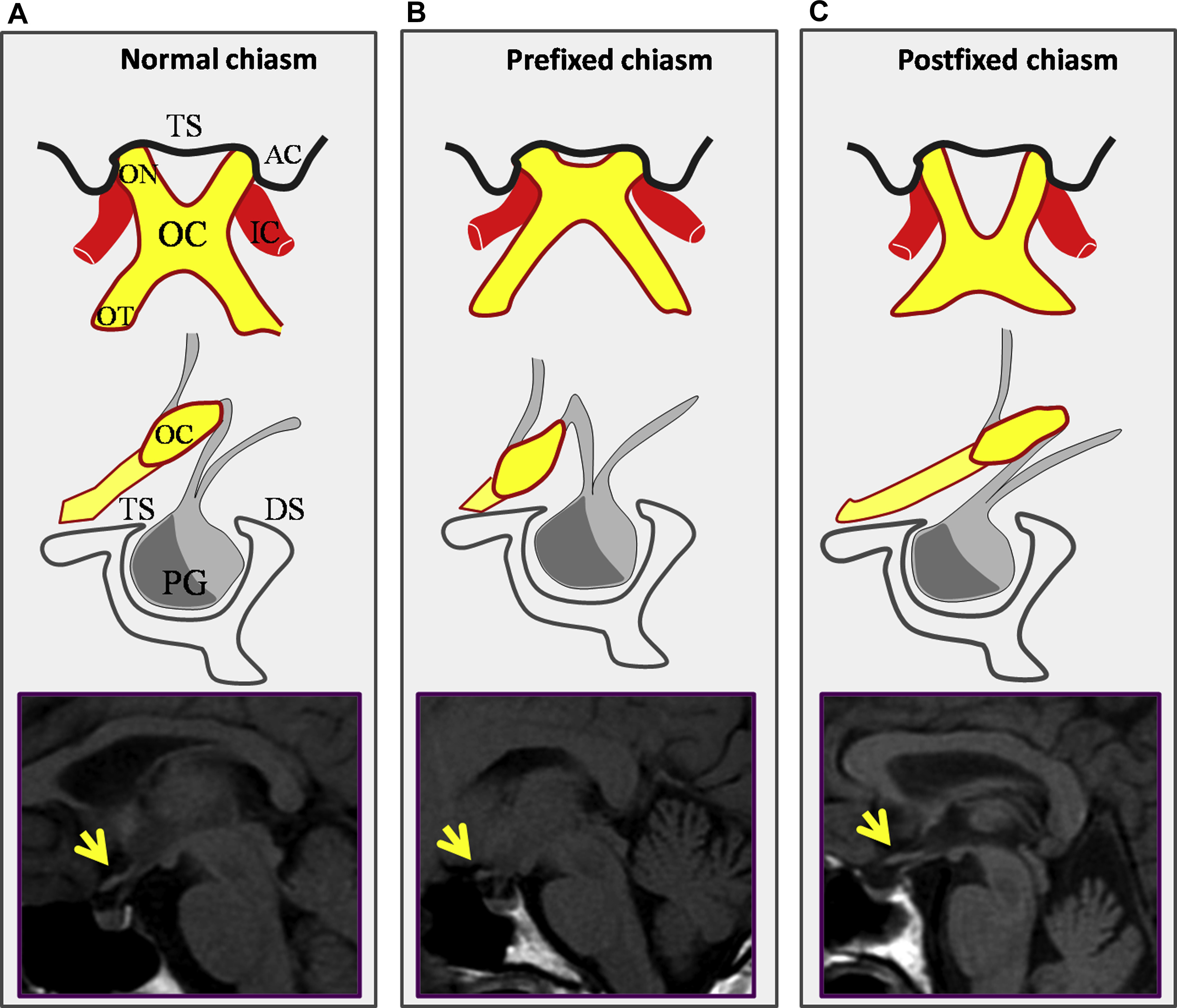 Anatomische Variationen des Chiasma opticum