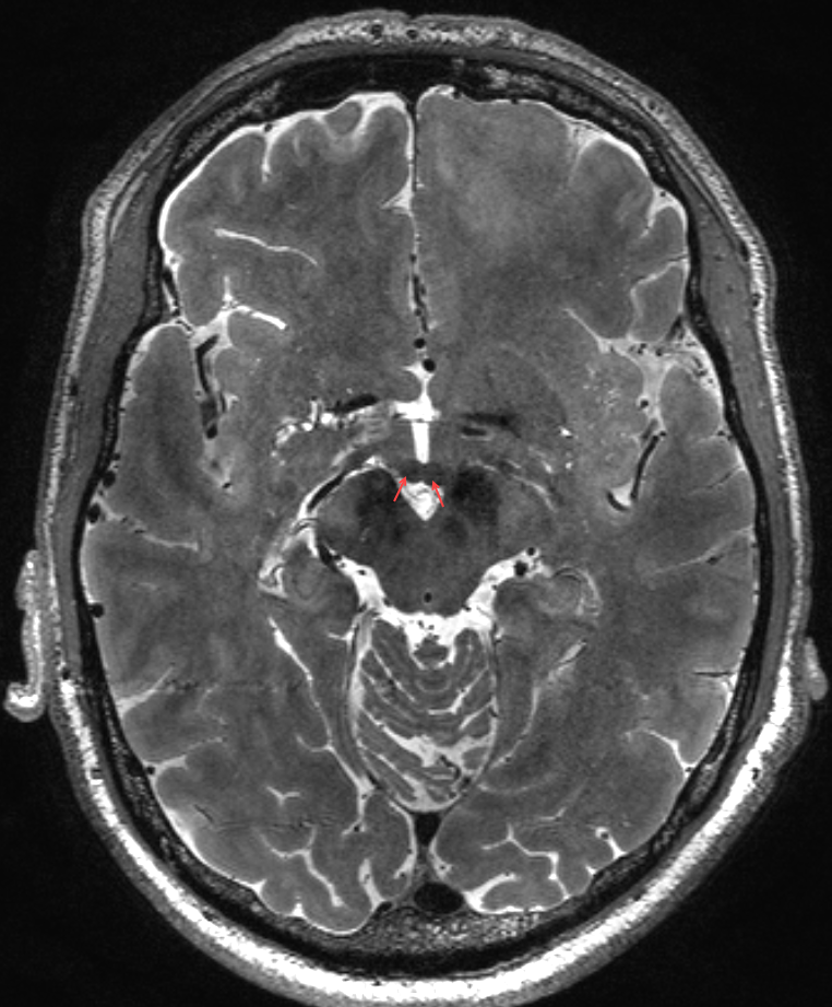 Corpora mamillaria im MRI