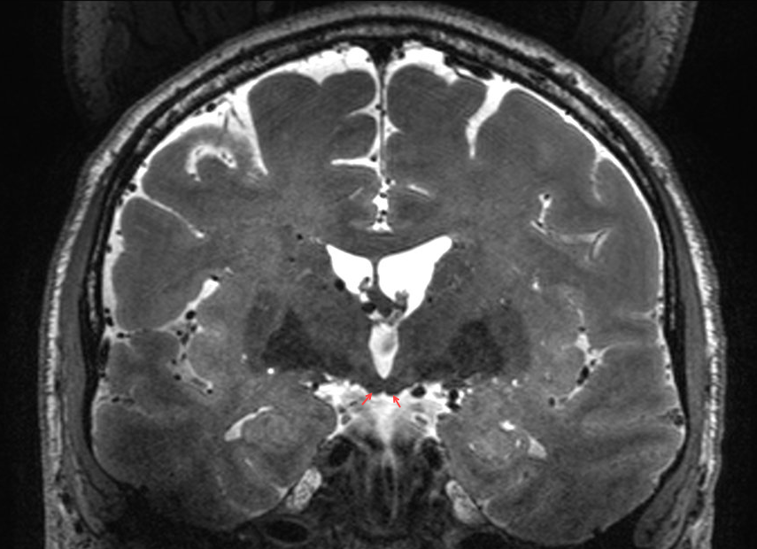 Corpus mamillare im MRI