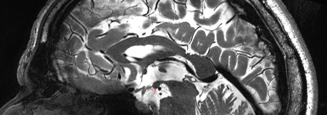 Corpus mamillare MRI
