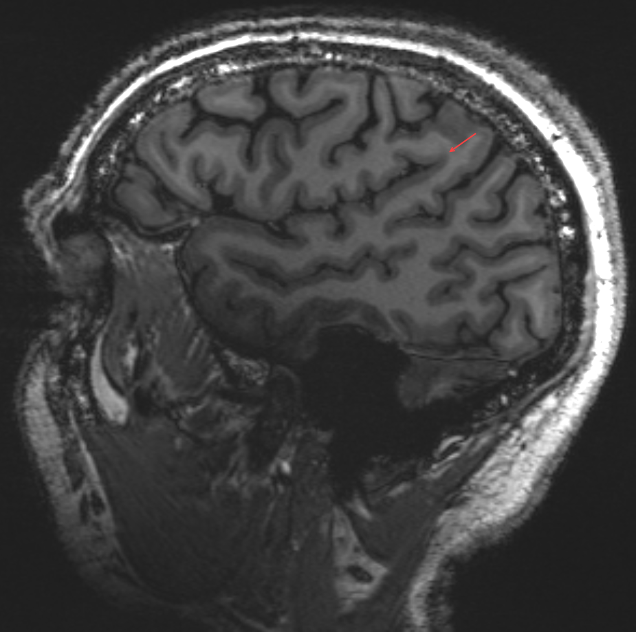 Gyrus supramarginalis im MRI