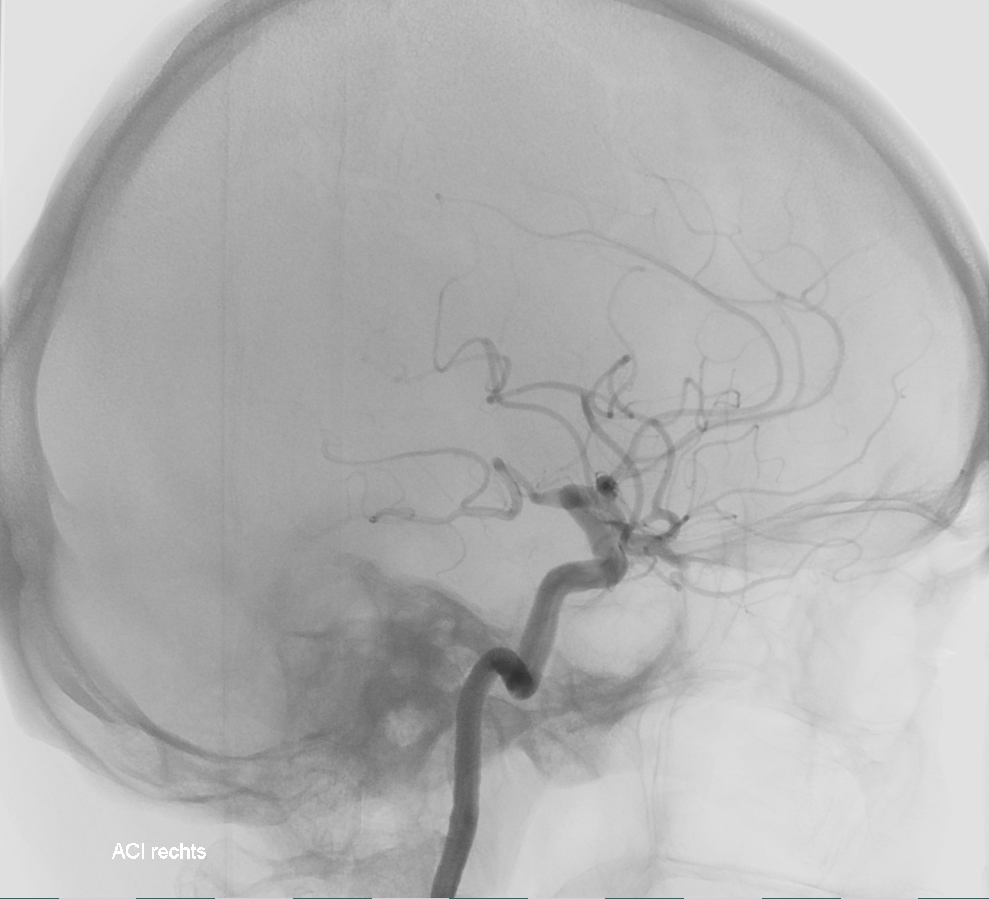 ICA Angiographie mit Knochen
