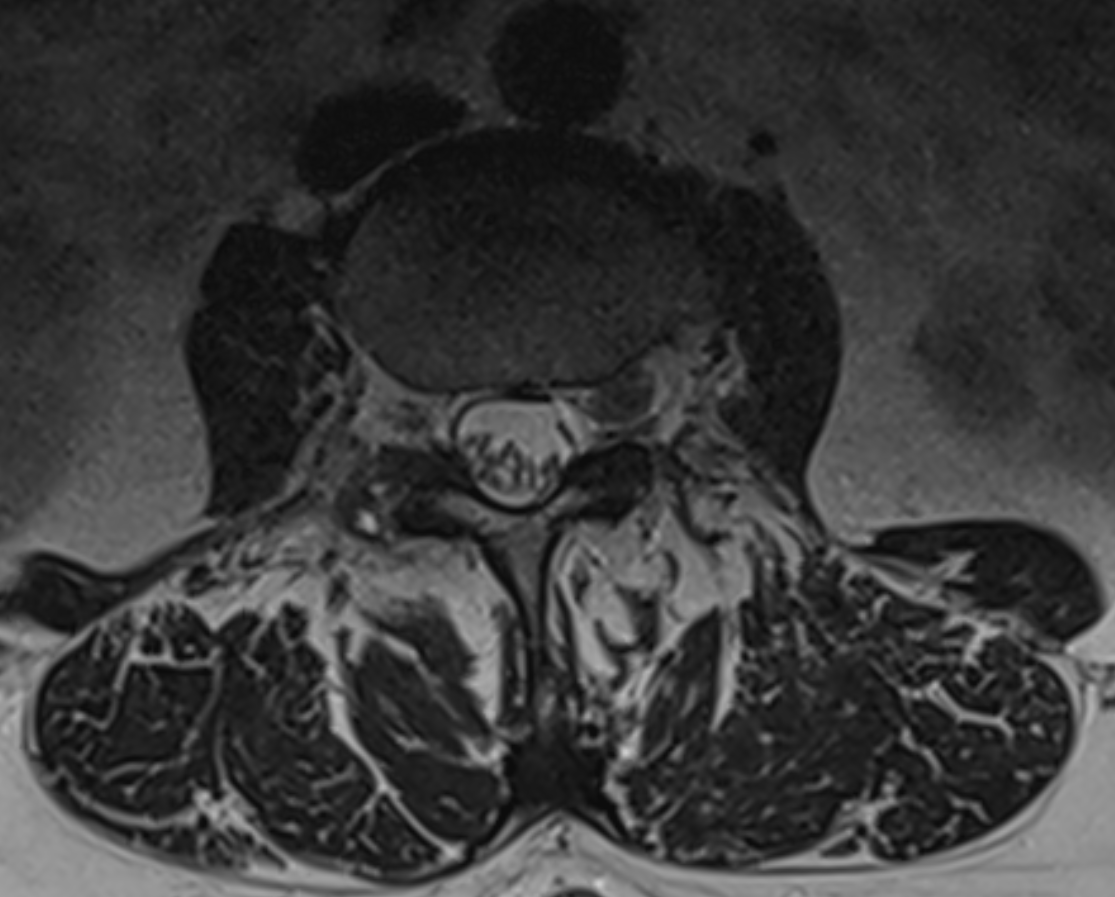 Intraforaminaler Bandscheibenvorfall im MRi