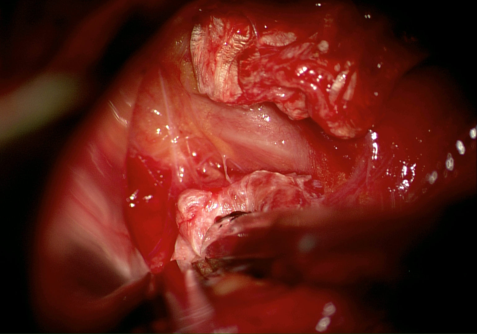 Gespaltenes Ligamentum transversum scapulae superius und Nervus suprascapularis intraoperativ