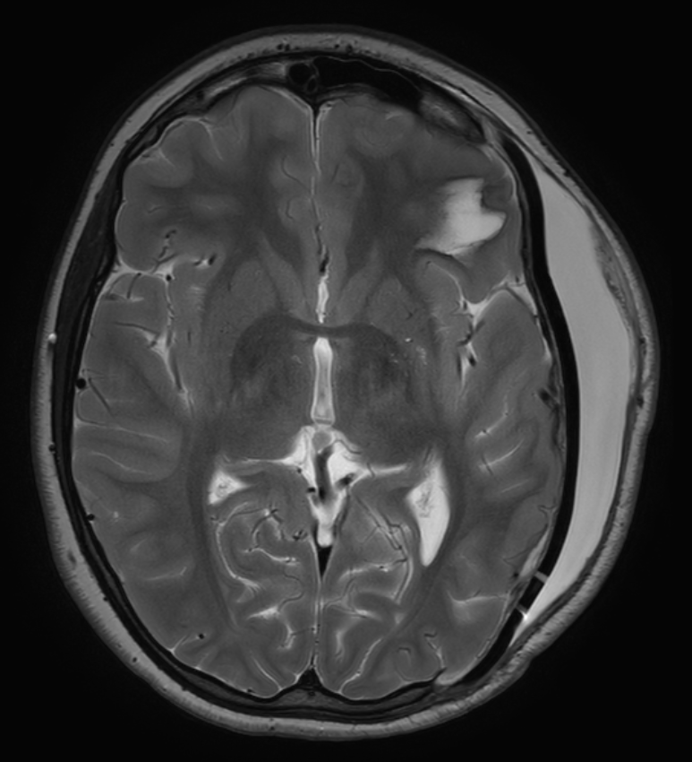 Liquorkissen MRI