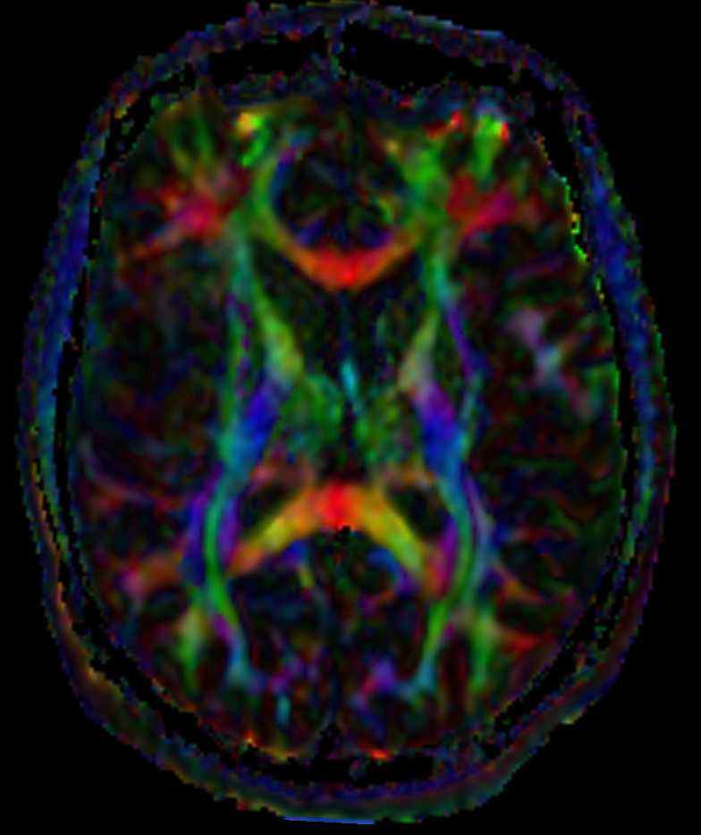 DTI Sequenz MRI