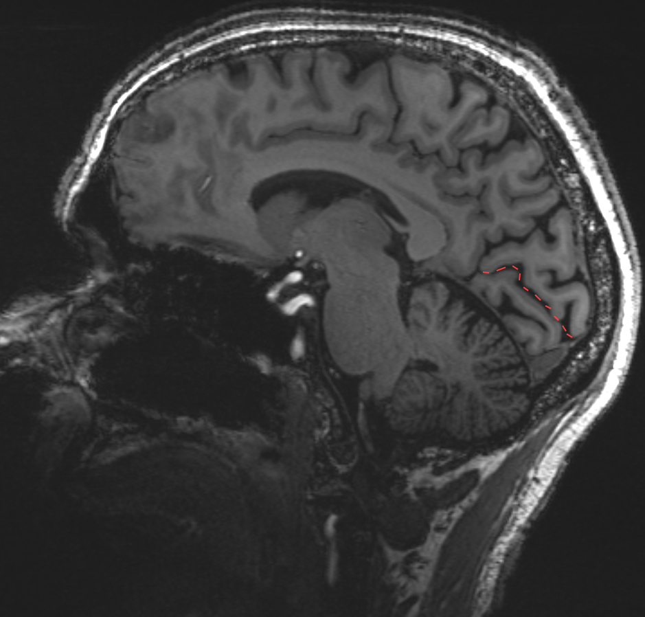Sulcus calcarinus im MRI