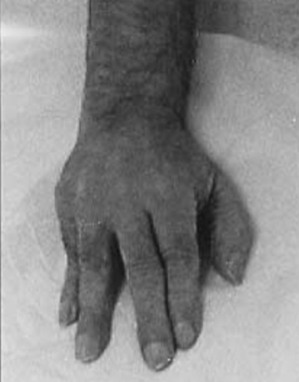 Thalamic hand