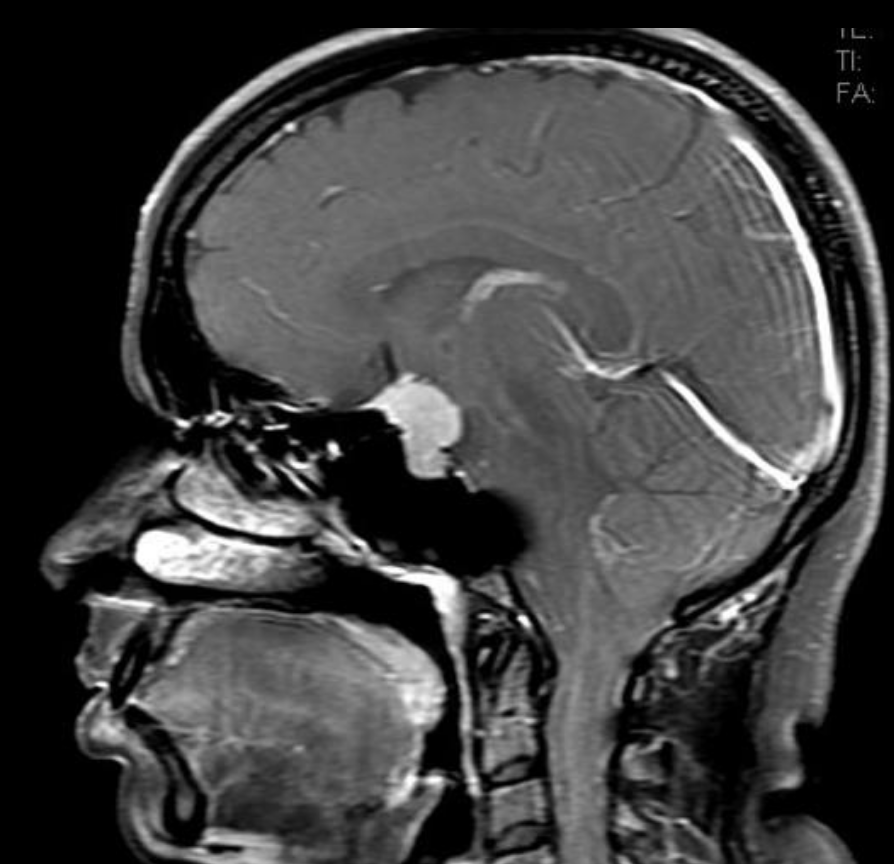 Tuberculum sella Meningiom MRT