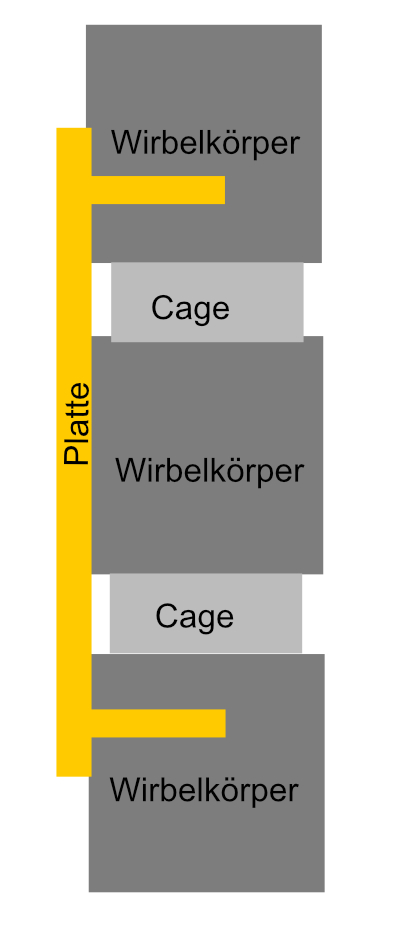 ACDF Platte Schematisch