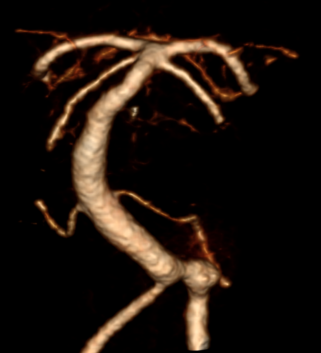 Aneurysma Arteria vertebralis