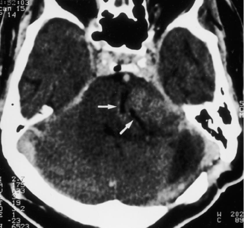 Cerebelläres Liponeurozytom CT