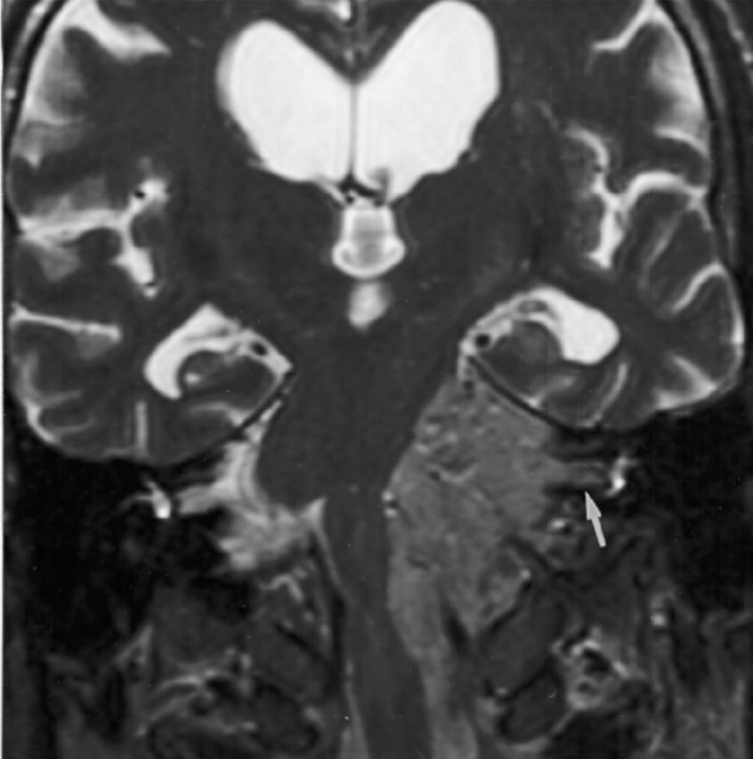 Cerebelläres Liponeurozytom T2 MRT Sequenz