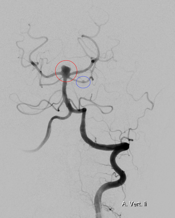 Aneurysma der SCA und Basilarisspitze