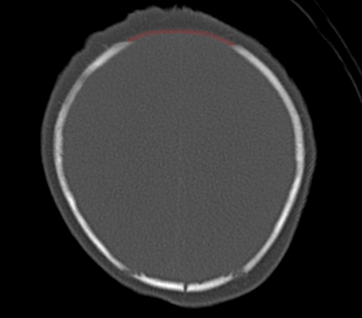 Fonticulus anterior axiales CT